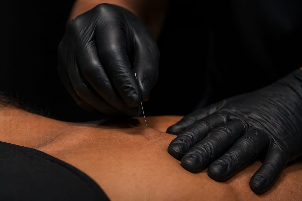 Dry needling